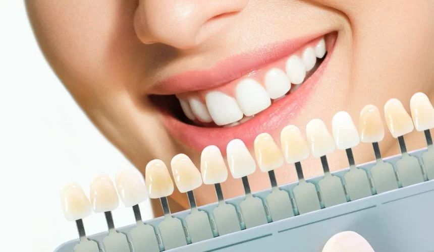 How Long Do Dental Veneers Actually Last With Proper Care?
