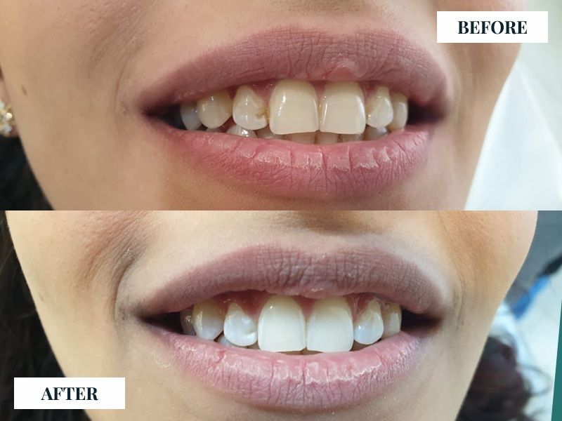 How to Choose the Right Option for a Cleaner Smile?